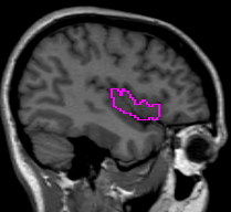 Circle around insula