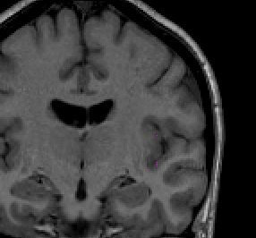 Insula in coronal view