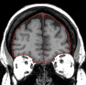 extract cortex and CSF