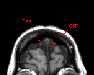 distinguish CSF from bone and dura
