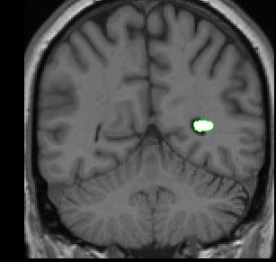 lateral-ventricle
