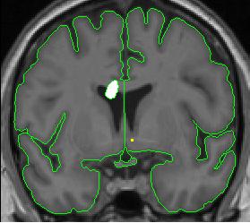lateral ventricle 2