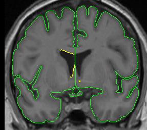 lateral ventricle 3
