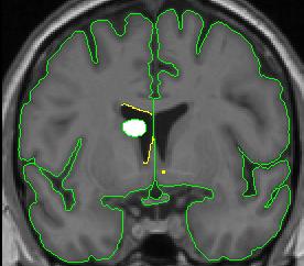 lateral ventricle 4