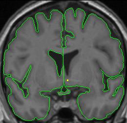 lateral ventricle 6
