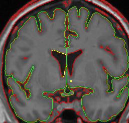 lateral ventricle 5